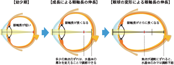 成長に伴って眼軸長が伸びて正視になるが、伸びすぎると近視になる