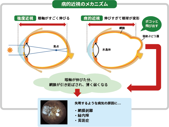 病的近視のメカニズム