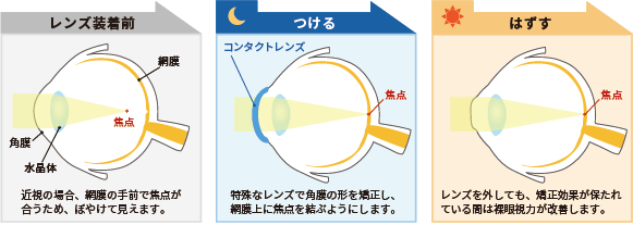 調節改善剤（ミオピン点眼液など）