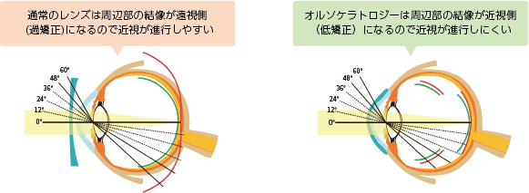 調節改善剤（ミオピン点眼液など）