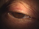 【症例２】眼瞼下垂症手術（眼瞼挙筋短縮術）