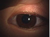 【症例３】霰粒腫穿刺と眼瞼マッサージでの治療