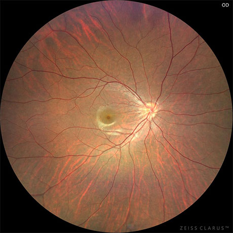 CLARUS500で撮影した眼底写真