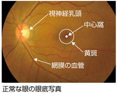 正常な眼の眼底写真