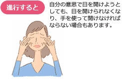 眼瞼痙攣の症状