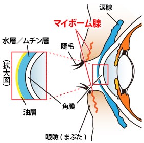 MGD（マイボーム腺機能不全）