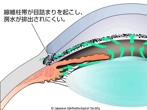 緑内障の視野