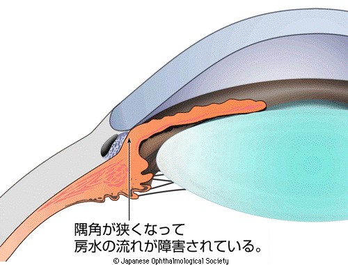 緑内障の視野