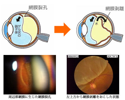 網膜裂孔