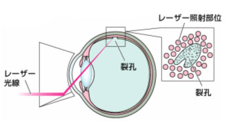 網膜裂孔