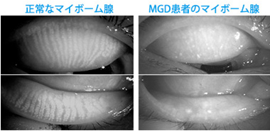 MGD（マイボーム腺機能不全）治療