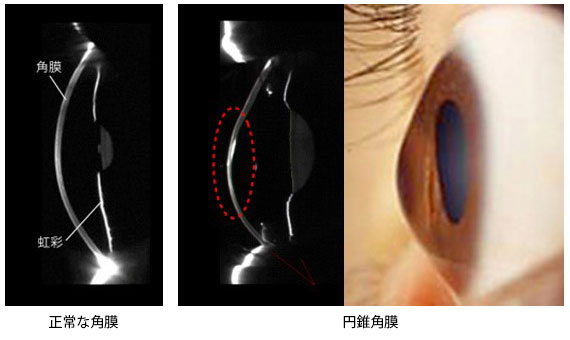 円錐角膜と正常な角膜の比較