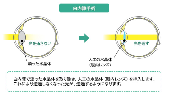 白内障の治療