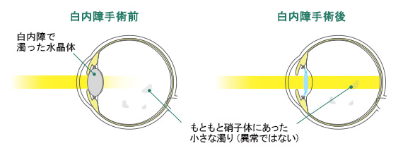 よくみられる術後症状 白内障 眼内レンズ手術 治療と手術 医療法人社団 医新会