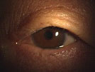 【症例１】眼瞼下垂症手術（眼瞼挙筋短縮術）