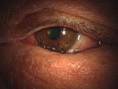 【症例２】眼瞼内反症手術（切開法）
