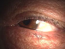 【症例２】眼瞼内反症手術（切開法）