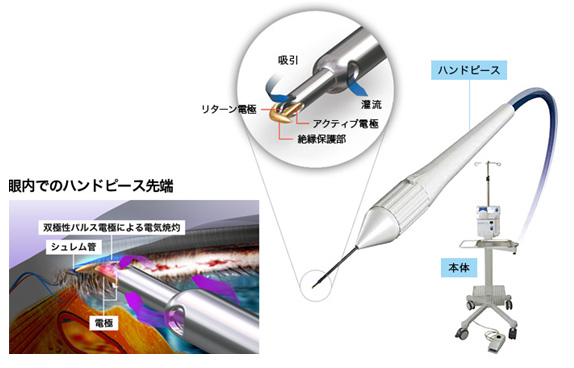 トラベクトーム（流出路再建術）