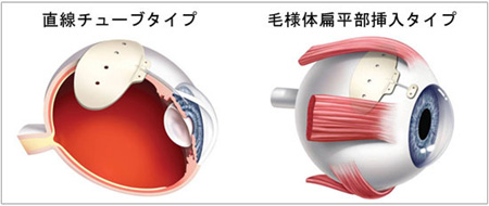 治る 緑内障 緑内障患者に希望の光を持たせる７つの最新治療のアイデア