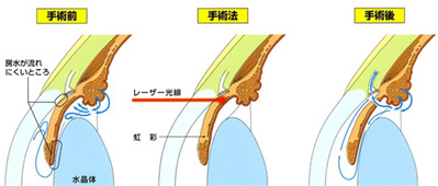 レーザー虹彩切開術（LI）