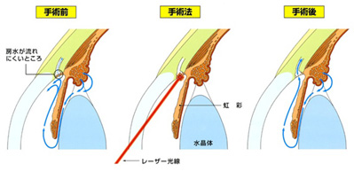 レーザー虹彩切開術（LI）