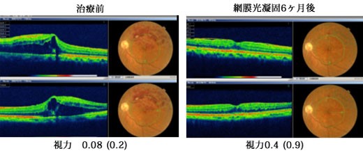 網膜中心静脈分枝閉塞症