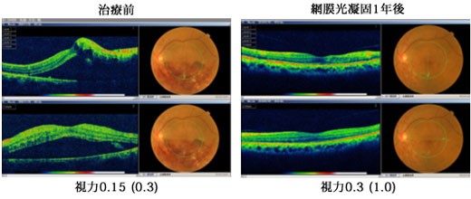 網膜中心静脈分枝閉塞症