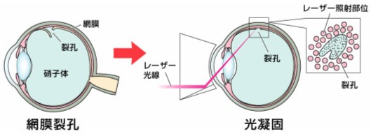 網膜裂孔