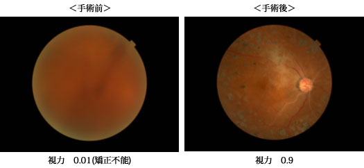 >網膜硝子体手術