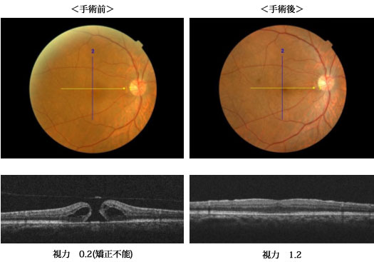 >網膜硝子体手術