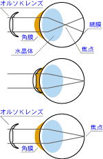 角膜形状矯正の仕組み