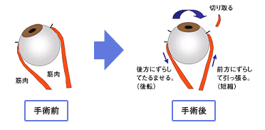 斜視の手術