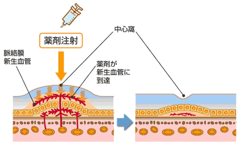 抗ＶＥＧＦ薬硝子体内注射