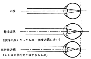 性 近視 軸